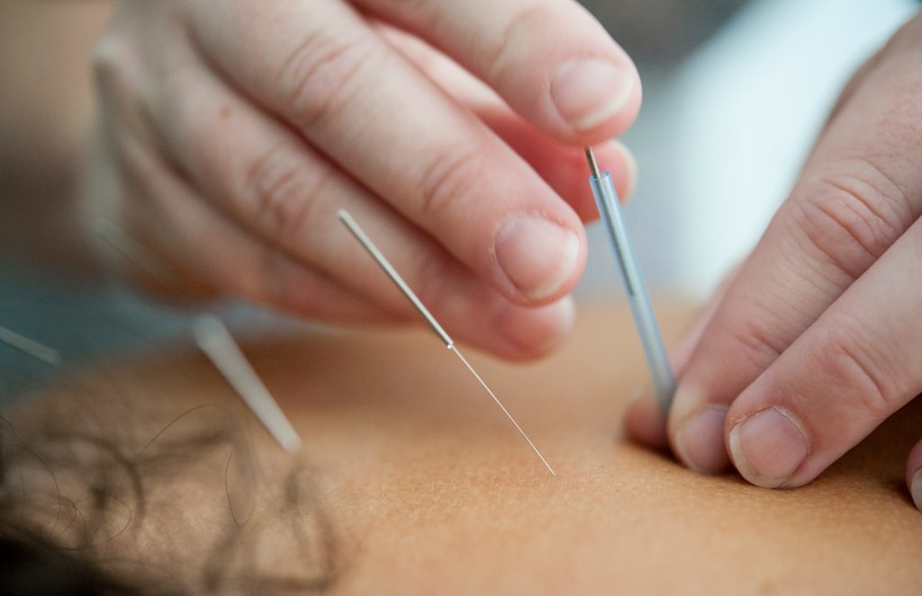 Close-up of a hand holding a silver acupuncture needle poised above a person lying down for treatment.